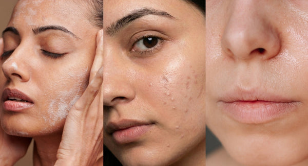 Sweat vs. Sebum: Why High Humidity Triggers Acne Breakouts