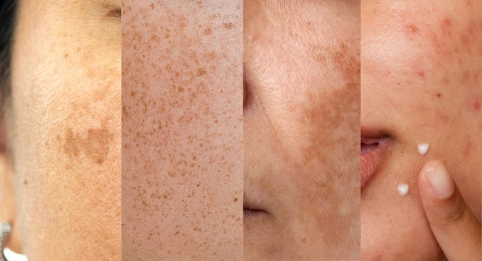 Why Indian Skin Pigments Differently Than Other Skin Types