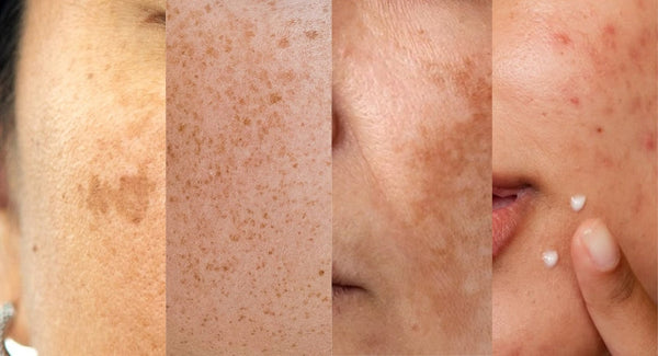 Why Indian Skin Pigments Differently Than Other Skin Types