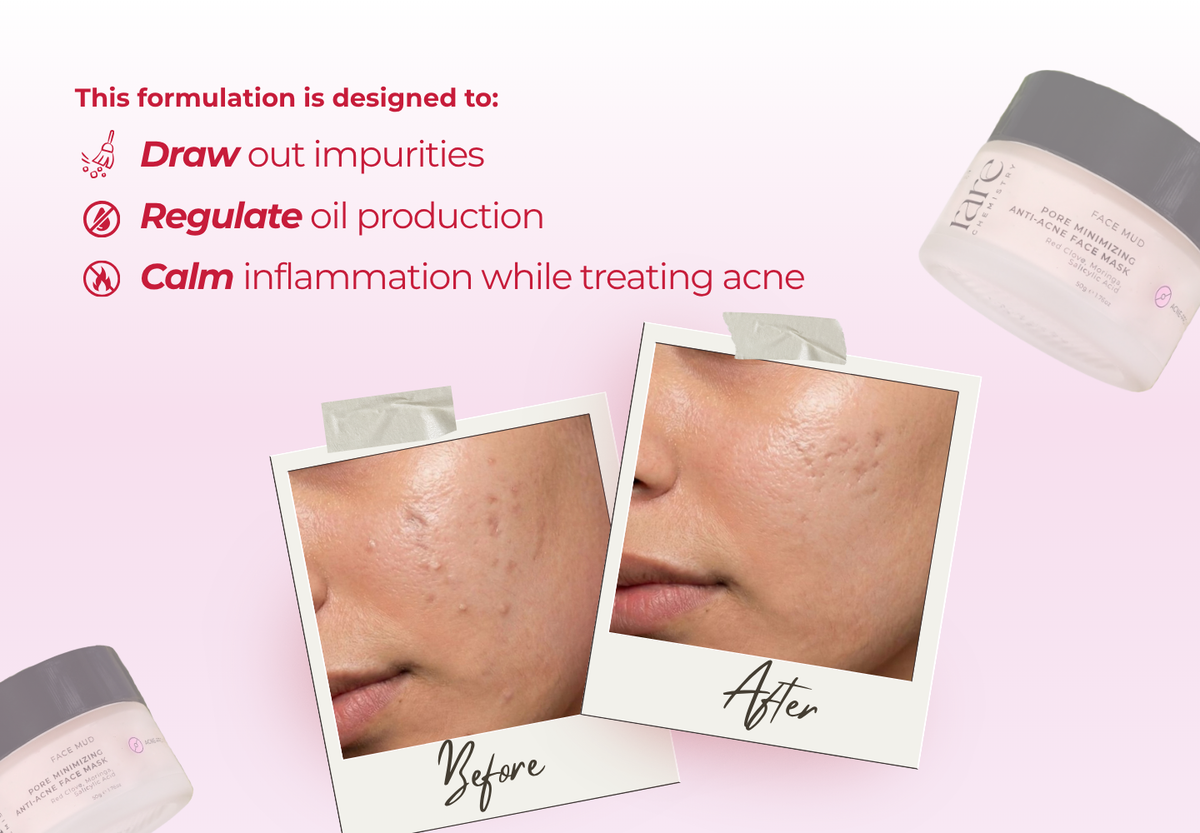 Pore Minimizing Anti Acne Face Mask