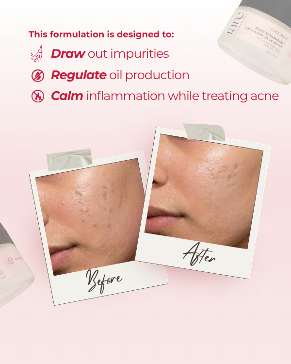 Pore Minimizing Anti Acne Face Mask