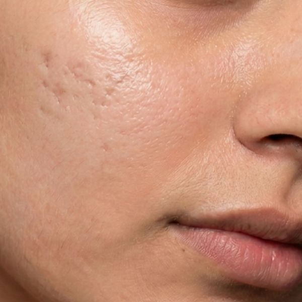 Acne Scars