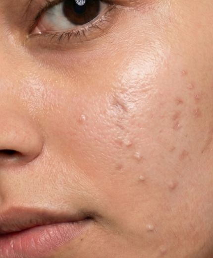 Oily Skin