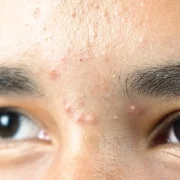 Oily and shiny, especially in the T-zone