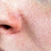 It becomes red and irritated easily
